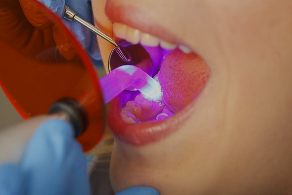 Composite Fillings in North Edmonton